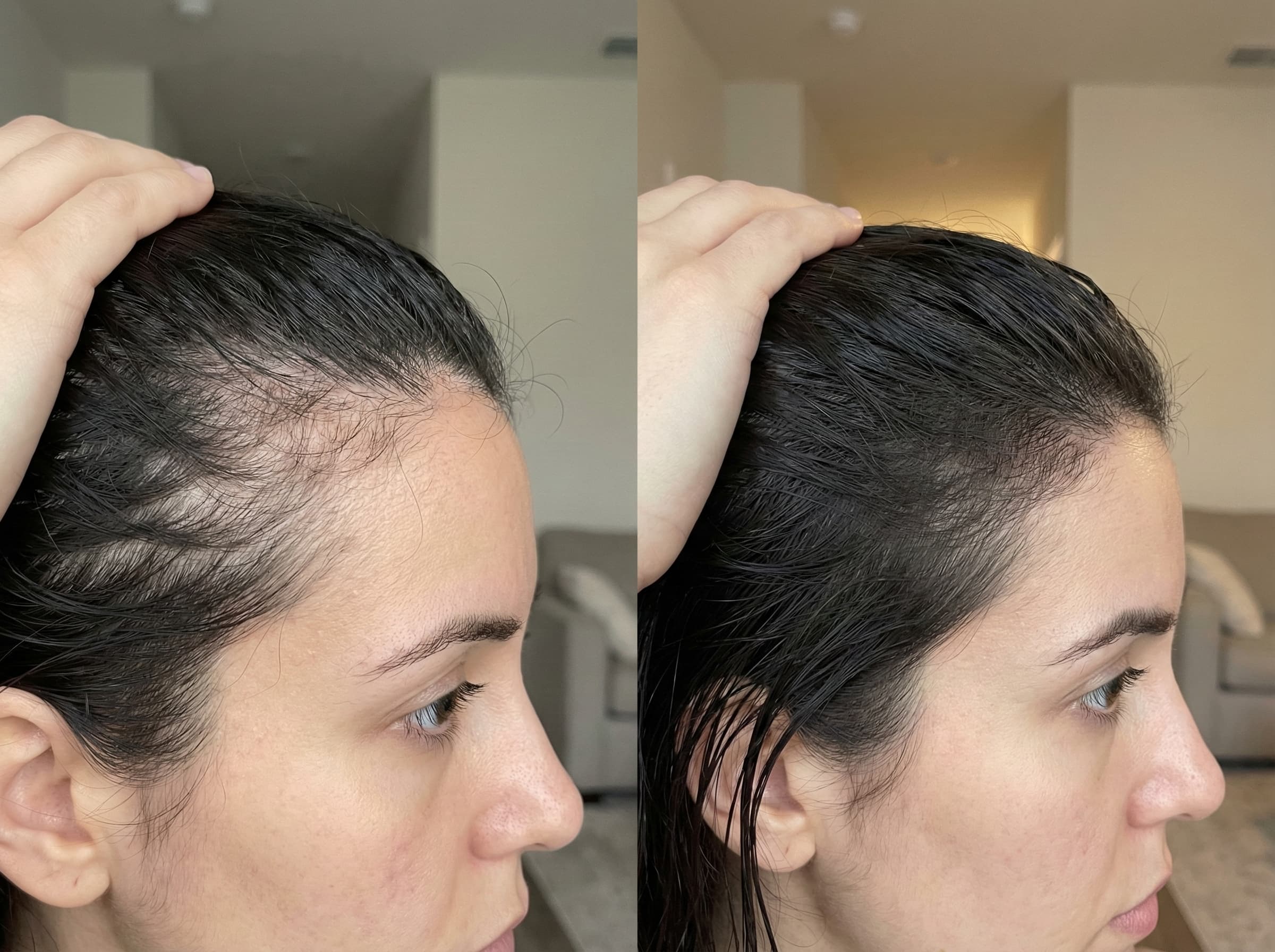 Before and after hair regrowth results