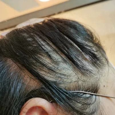 Donna N. before treatment